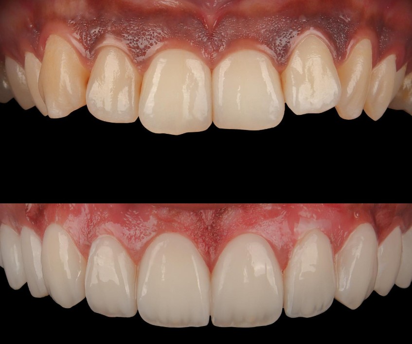 Smile Makeover